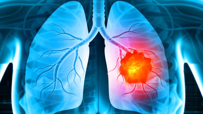 Mattew Evison: Single station vs multi station N2 as a defining factor for resectability of lung cancer