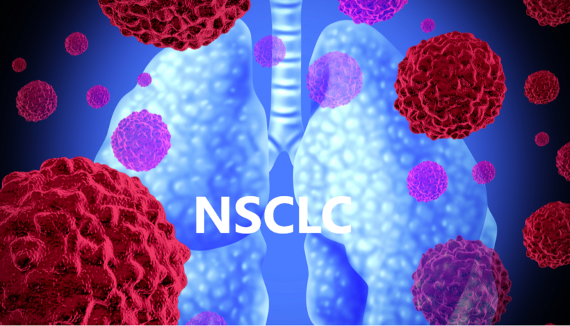 PD-L1 and durvalumab after chemoradiation for stage III NSCLC in Netherlands Cancer Registry