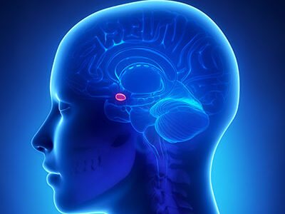Angela Mastronuzzi: Gliomatosis cerebri in children