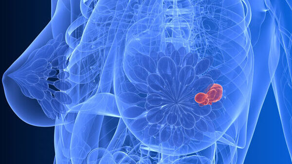 Identification of Resistance Biomarkers to HER2 Inhibitors