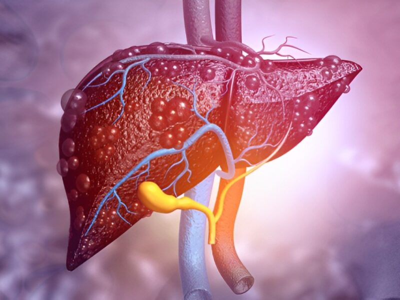 Immunotherapy use and effectiveness in Child-Pugh class B