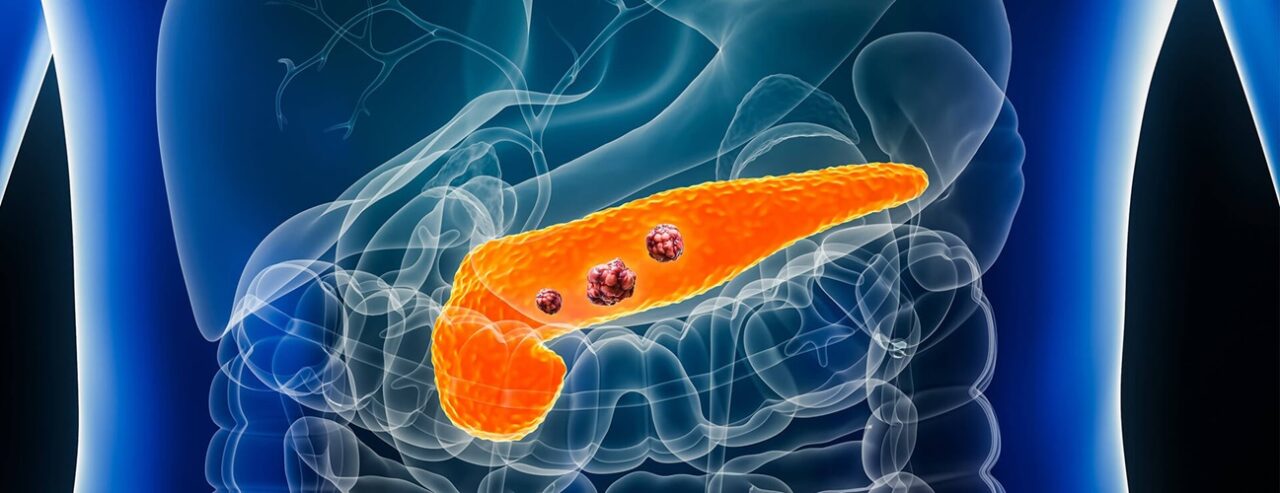 Anirban Maitra: The first concerted attempt at setting research priorities for progress in Pancreatic Cancer