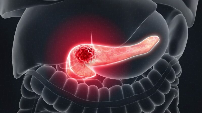 Distinct molecular and clinical features of KRAS G12 mutations in Pancreatic Cancer