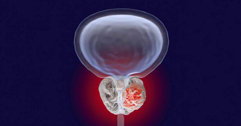 SMA-PET in Biochemically Recurrent Prostate Cancer: A Paradigm Shift