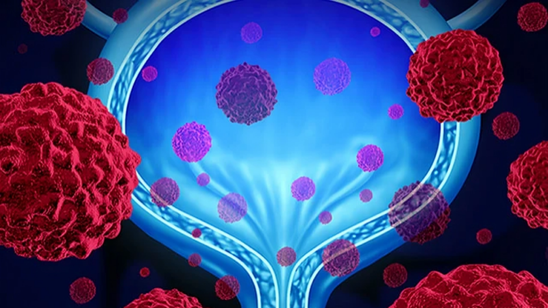 Can Clinical Complete Response Replace Cystectomy in MIBC? – European Urology Oncology