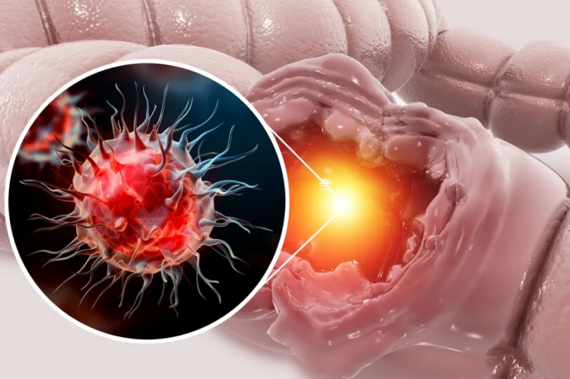 An Oxford study found that a glass of milk a day was linked to 17% lower bowel cancer risk