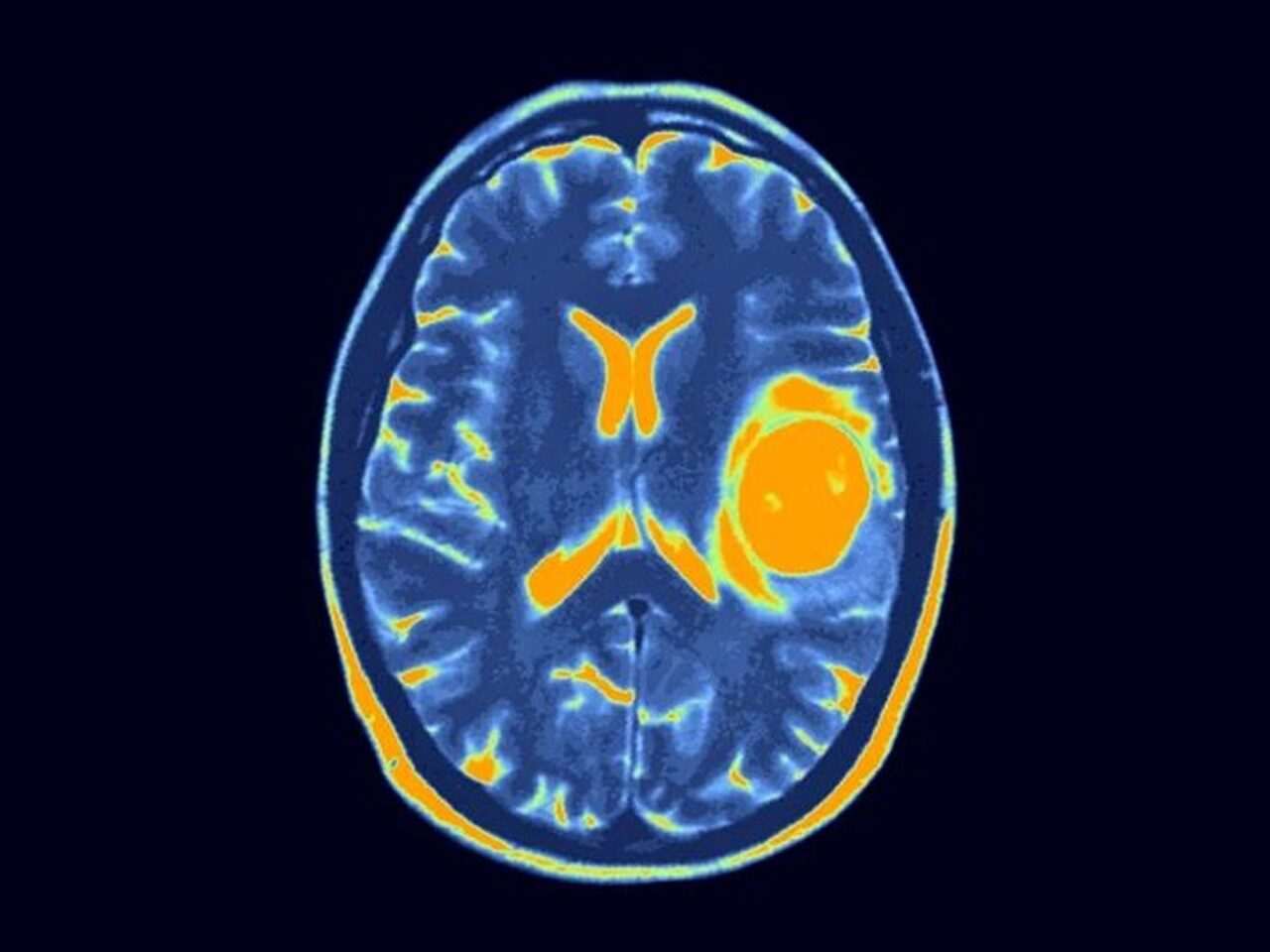 Hope in CAR-T Therapy: Promising Results in Incurable Pediatric Brain Cancer