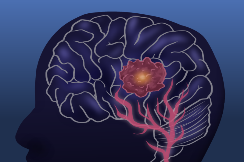 The first patient in the United States to undergo an experimental treatment for glioblastoma