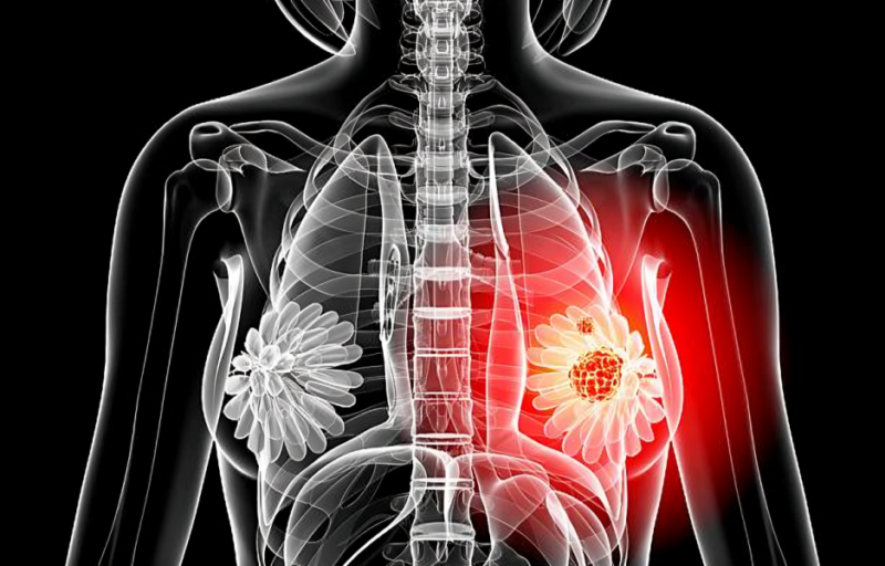 Elisabetta Bonzano: Internal Mammary Lymphadenopathy in Patients Treated with Neoadjuvant Chemotherapy