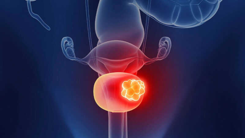 VI-RADS Scores for Muscle-Invasive Bladder Cancer