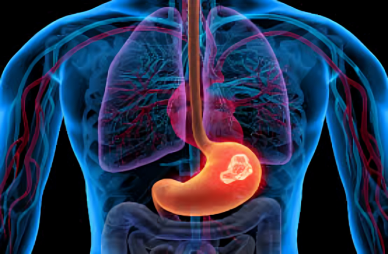 Florian Lordick: New first-line treatment algorithm for advanced gastric cancer published in ESMO