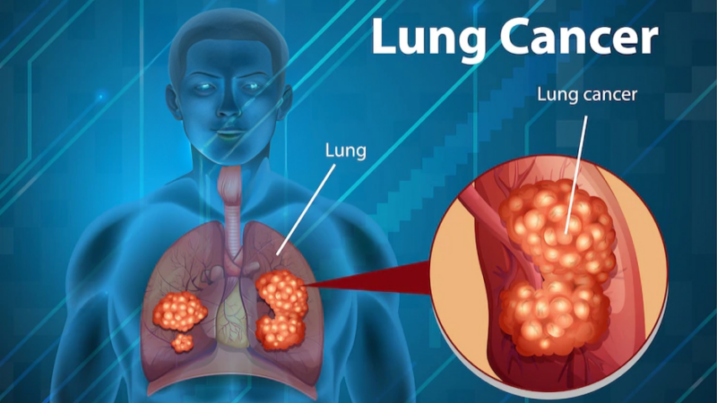 Katsuaki Maehara: New histopathologic indices to predict postoperative recurrence of lung cancer