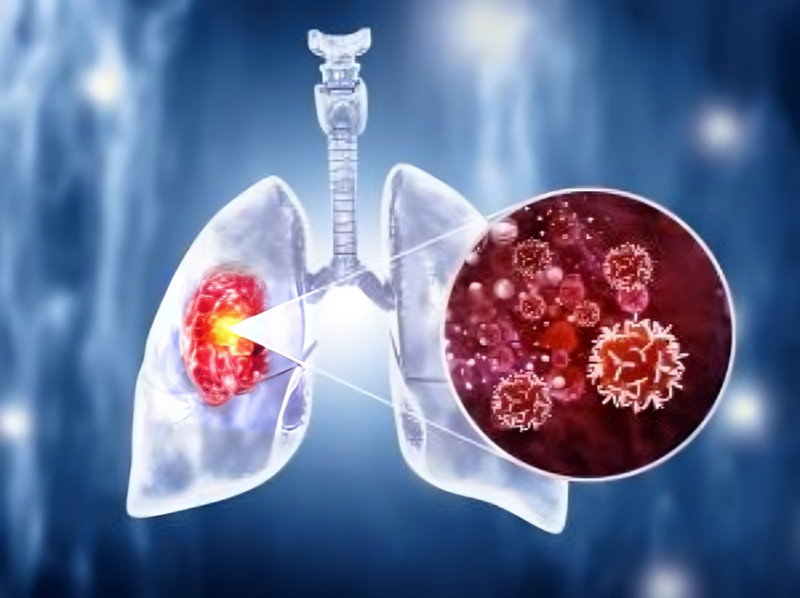 Neoadjuvant osimertinib for resectable EGFR NSCLC