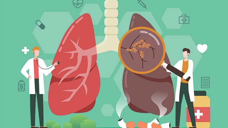 NCCN Guidelines Insights: Lung Cancer Screening, Version 1.2025