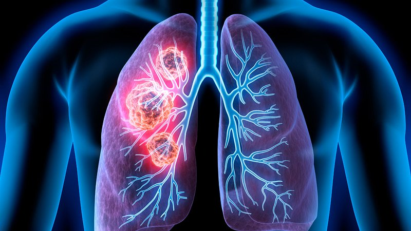 Clinical Impact of SVGs of Oncogenes and Tumor Suppressor Genes in Previously Treated Advanced NSCLC