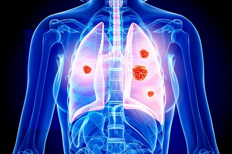 Mariano Provencio: Perioperative chemotherapy and nivolumab in NSCLC