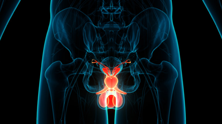 María Natalia Gandur Quiroga: Study on Gleason Grade Group 1 Prostate Cancer reveals key findings