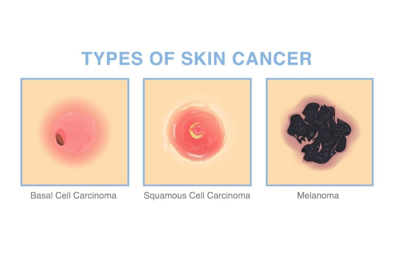 Conquer Cancer, the ASCO Foundation – Lynn Schuchter and Brenda Brody talk about skin care prevention