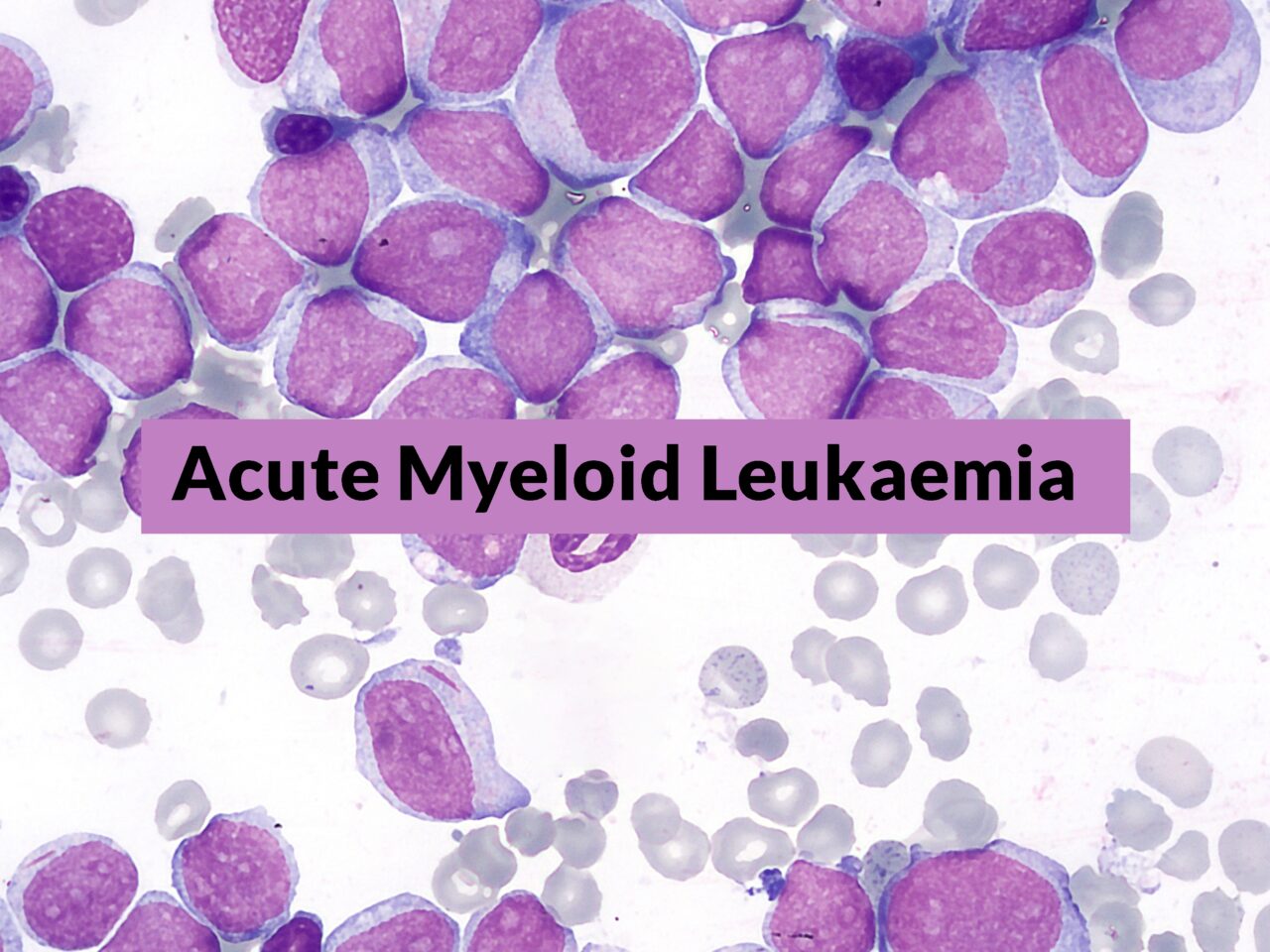 New ELN classification of AML receiving less intense therapies