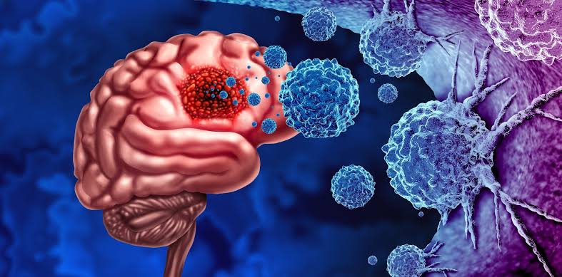 Castalia Fernández: The molecular era of treatment of gliomas