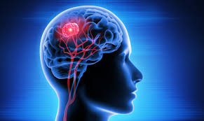 Children’s Cancer and Leukaemia Group funded new research aimed at diagnosing relapsed ependymoma sooner