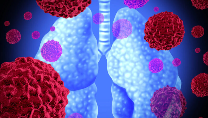 Neoadjuvant Ipilimumab, Nivolumab vs Chemotherapy in NSCLC