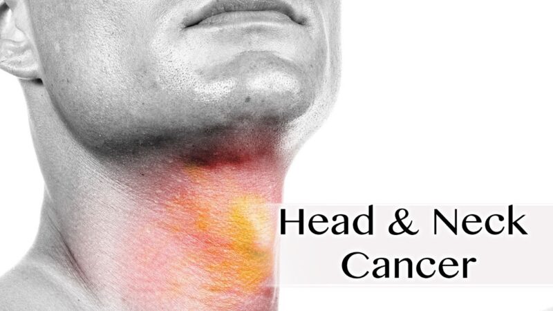 Chronic fatigue among long-term head and neck cancer survivors