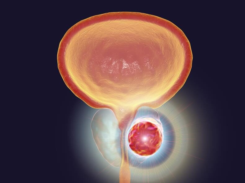 Analysis of cfDNA Reveals Stemness Linked to Poor Survival in Lethal Prostate Cancer
