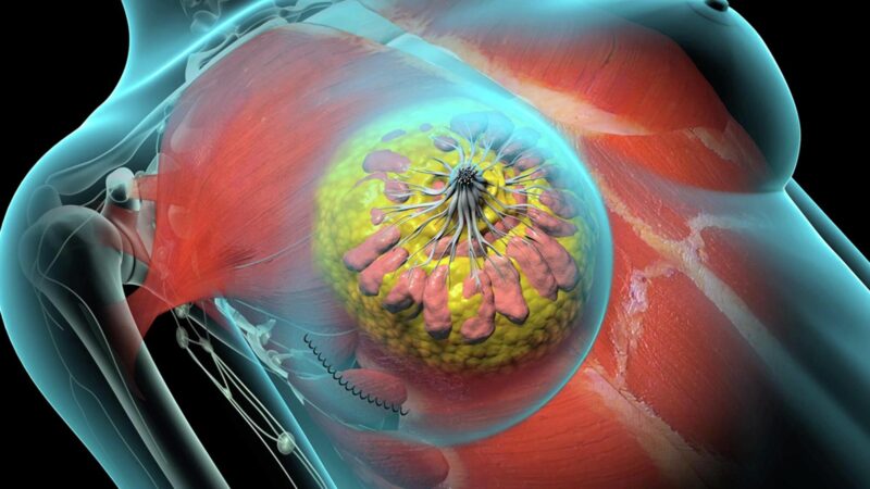 Residual breast tissue after mastectomy and reconstruction