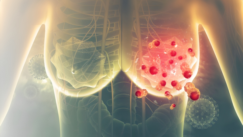 Immunotherapy for aggressive breast cancer appears to be effective even without chemotherapy – The Netherlands Cancer Institute