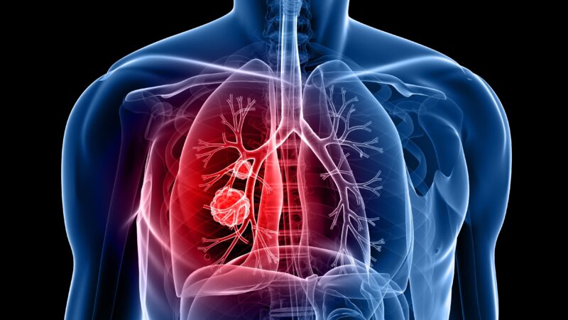 Important ad hoc analysis of JCOG 0802 for local recurrence