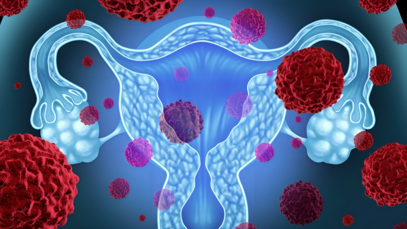 Shahrin Ahmed: Deeper understanding of postmenopausal bleeding and endometrial cancer