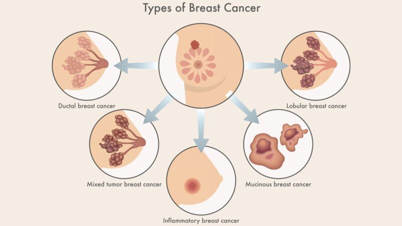 breast cancer types