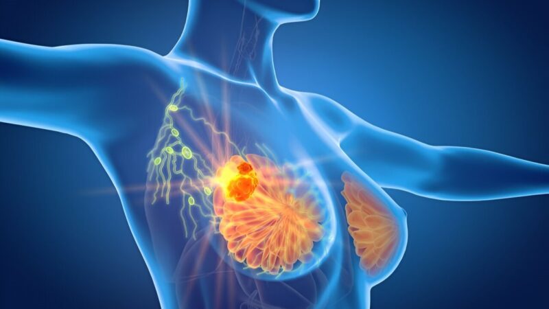 Elisa Agostinetto: Camizestrant vs Fulvestrant for estrogen receptor-positive, HER2-negative breast cancer