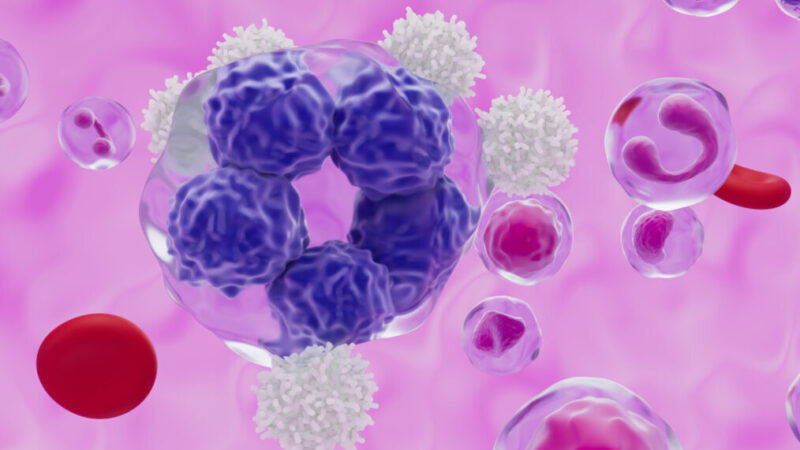 Raul Cordoba: Early progression beyond first-line chemoimmunotherapy in follicular lymphoma by Alberto Bavieri et al
