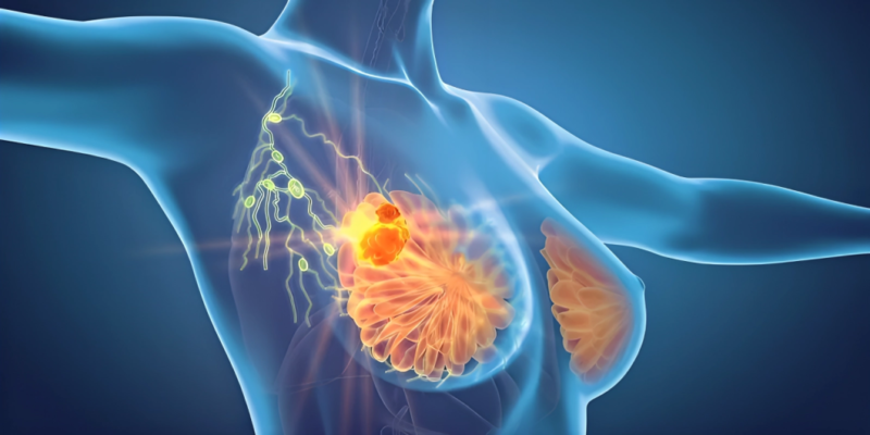 Imlunestrant with or without Abemaciclib in Advanced Breast Cancer
