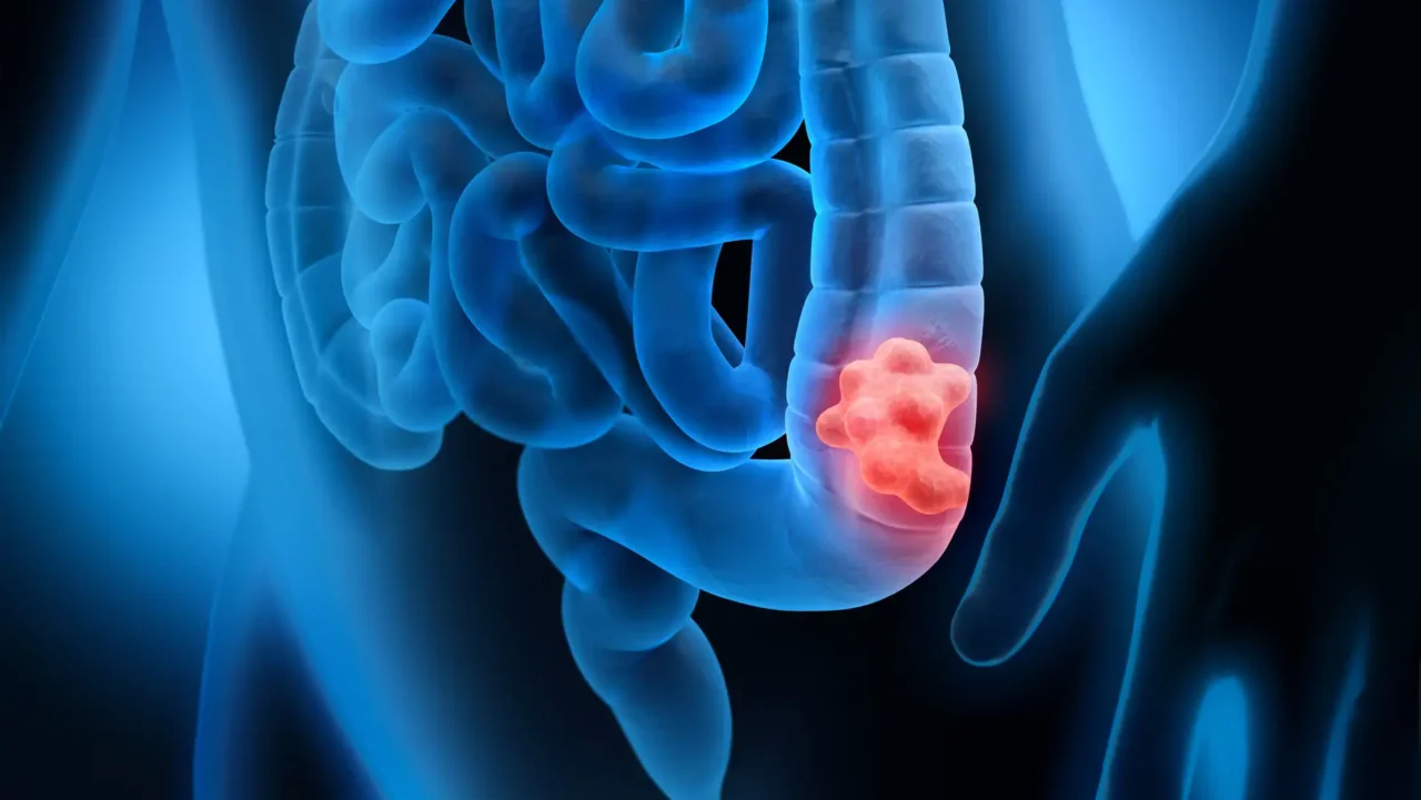 Important biomarker analyses for T-DXd in HER2-expressing Metastatic colorectal cancer