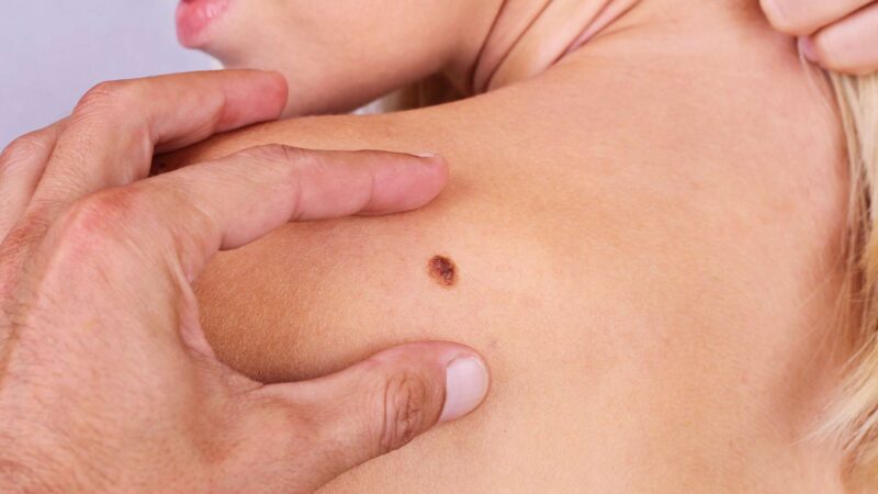 Three-Year Overall Survival with Nivolumab + Relatlimab rela-nivo in Advanced Melanoma