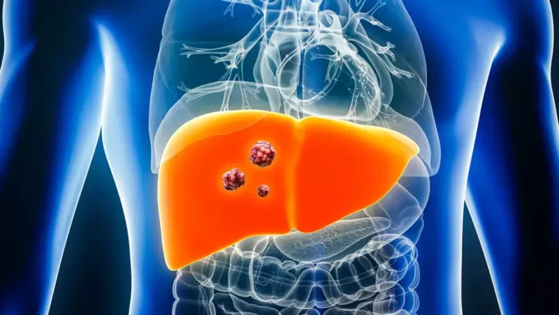 Senthil Kumar: First-Line Therapy in HCC – The New Era of Choices