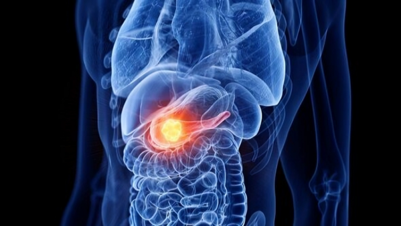 Ryan Nipp on how Supportive Oncology and focusing on PROs is helpful for patients with pancreatic cancer