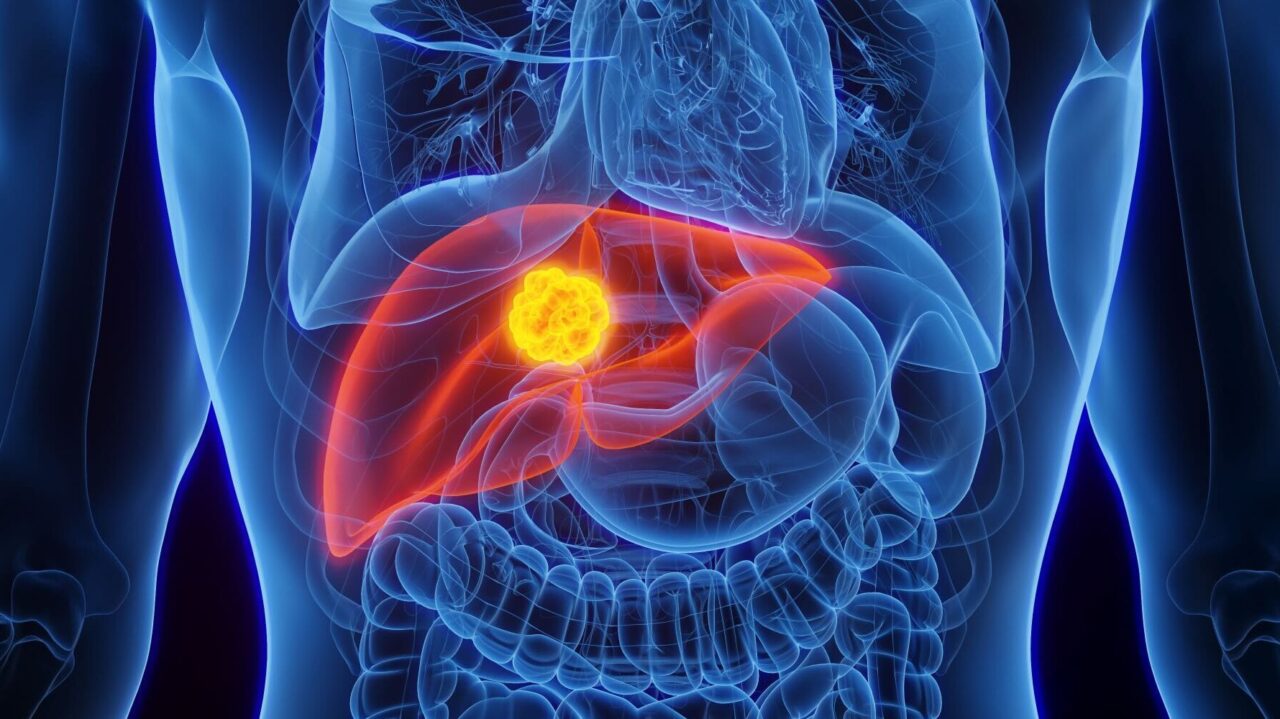 Liver Transplantation for Hepatocellular Carcinoma