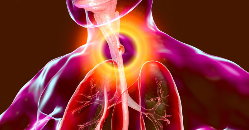 Erman Akkus: Role of PD-L1 expression in advanced esophageal SCC by Manavi Sachdeva et al