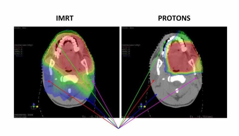proton beam therapy
