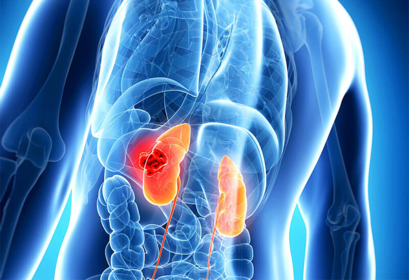 Giuseppe Procopio: Results of the prospective multicenter Cassiope trial in renal cell carcinoma
