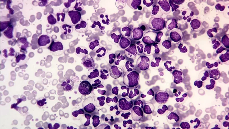 Ahmed Kotb: FLT3 Inhibitors choice in AML