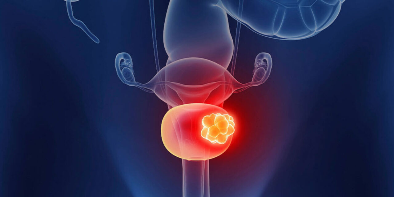 Laura Bukavina: Microbiome analysis of Fresh Frozen vs FFPE tissue in bladder cancer by Dominik Enderlin et al