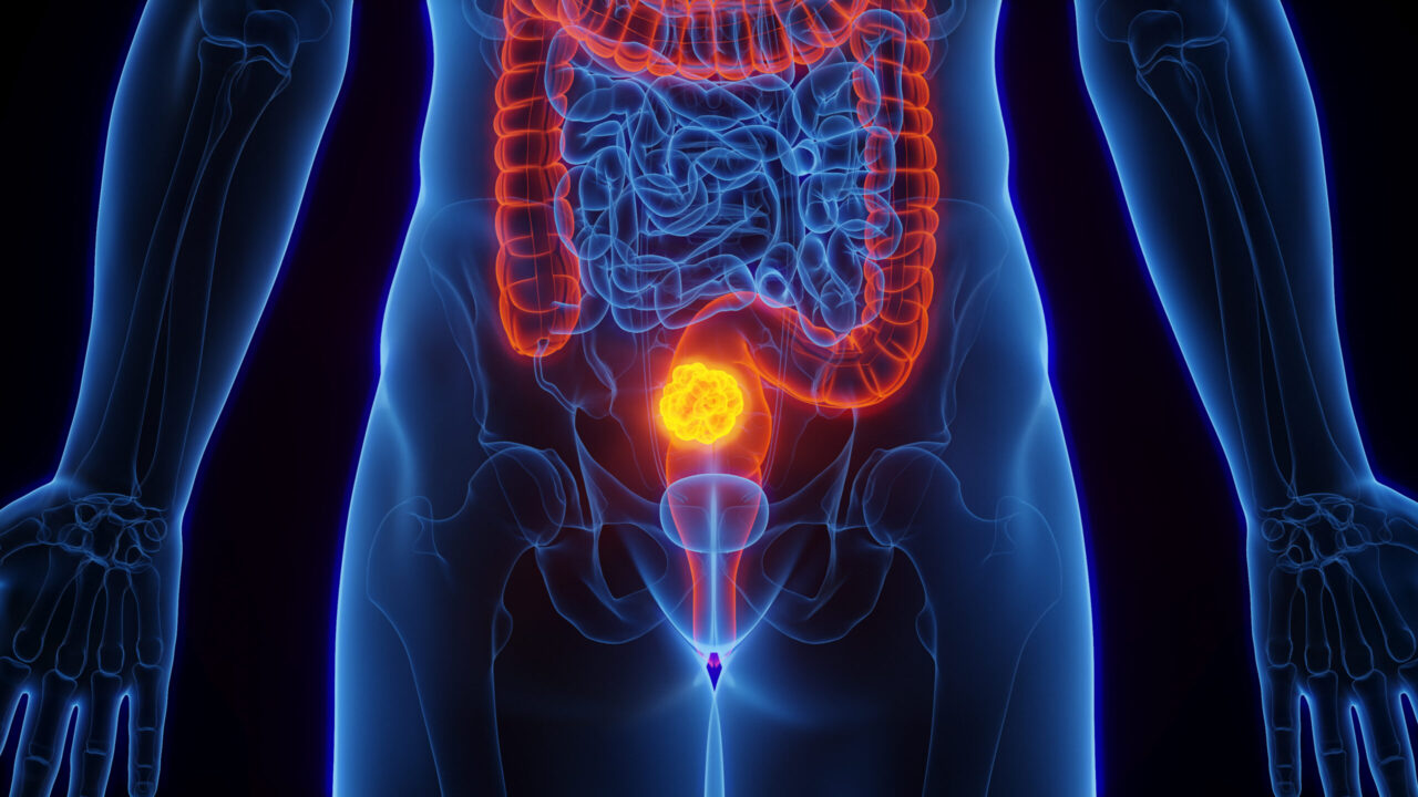 Concomitant PPIs and capecitabine-based chemoradiotherapy in rectal cancer