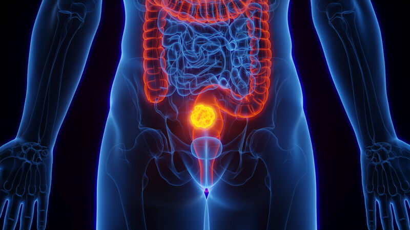 Concomitant PPIs and capecitabine-based chemoradiotherapy in rectal cancer