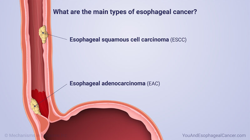 esophageal cancer