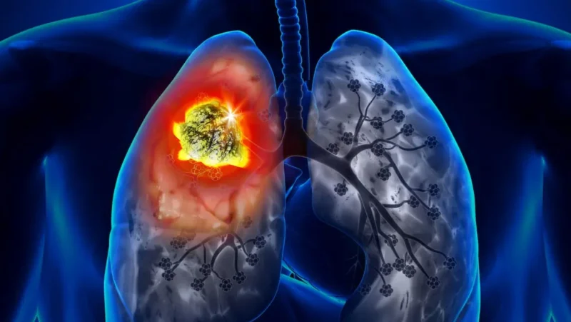 Xiuning Le: Personalized Care for EGFR-mutant NSCLC